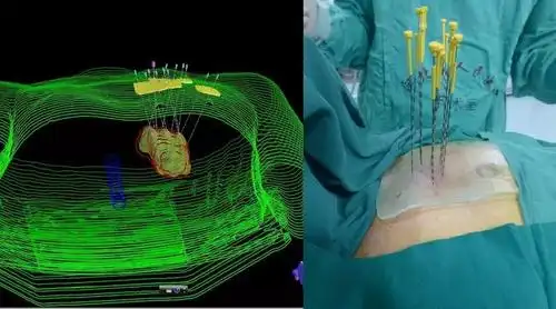 新突破 | 世界首例术中计划 3d打印模板肺癌粒子植入术