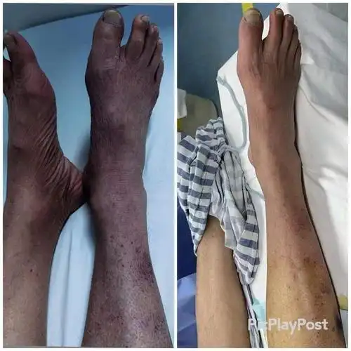 "肢梗"专业术语为下肢动脉硬化闭塞症,其危害不亚于脑梗和心肌梗死.