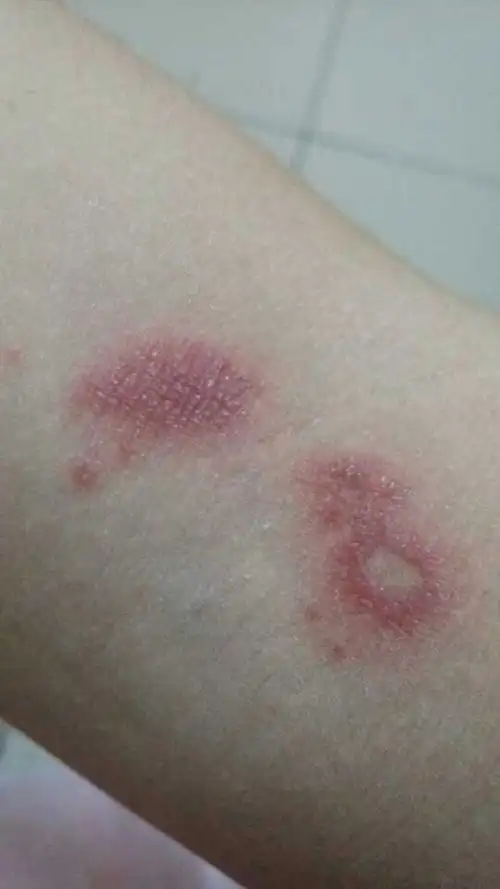 皮肤出现红斑,不知是过敏还是被昆虫叮咬