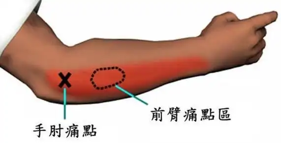 网球肘在哪个位置图片,网球肘的按摩手法自我治疗视频图解
