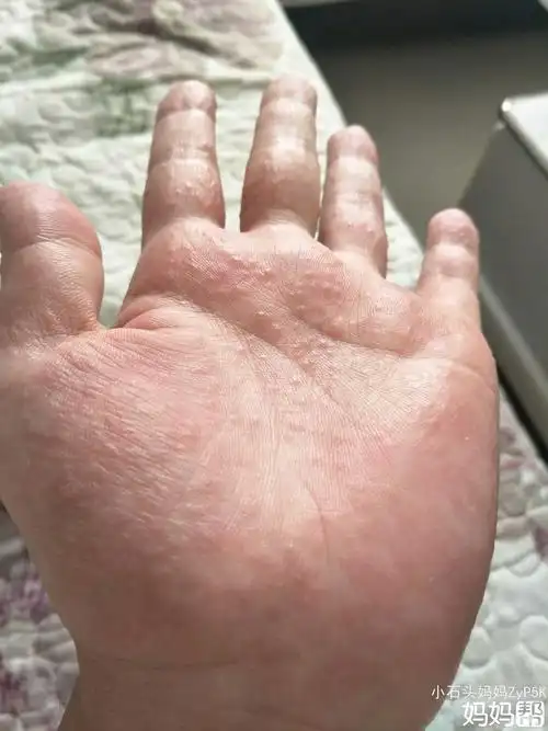 鹅掌风药粉_鹅掌风传染吗_鹅掌风治疗