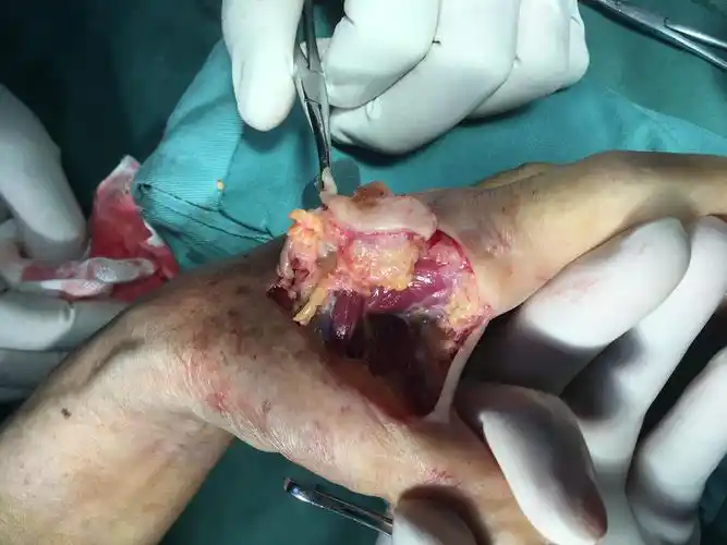 一例皮肤恶性肿瘤,左手虎口处肿物渐进性增大伴反复溃