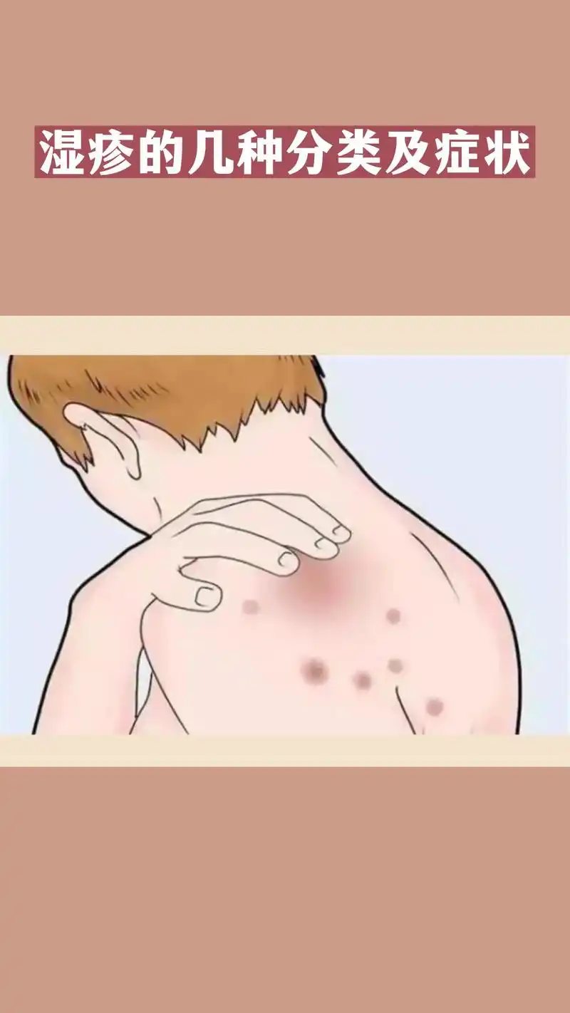 中医 #湿疹 #皮肤 - 抖音