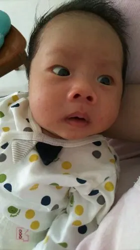 小宝宝有斗鸡眼怎么办