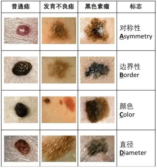 全国肿瘤防治宣传周 | 警惕黑痣变为黑色素瘤!_治疗_颜色_癌变