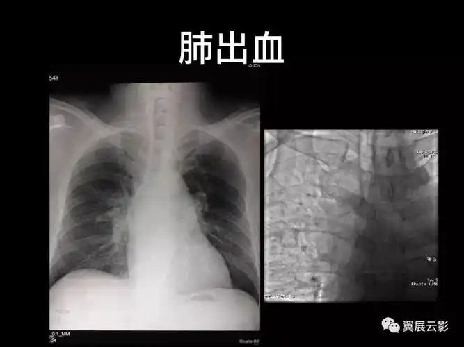 经典回顾肺栓塞影像诊断与鉴别