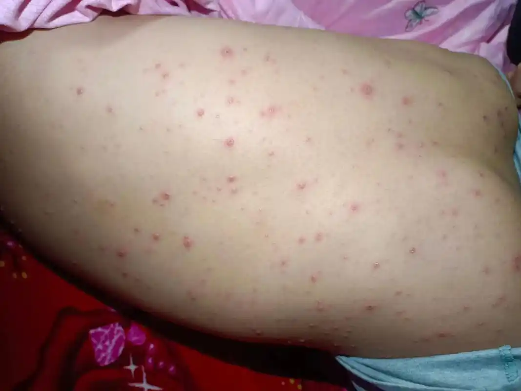 皮肤科#水痘 @抖音小助手 @皮肤科教授张堂德 @皮肤科教 - 抖音