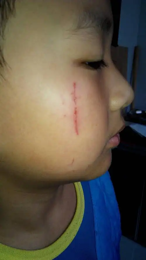 17lv4 擅长:暂未定制 向ta提问私信ta  展开全部 外伤未伤及真皮层是