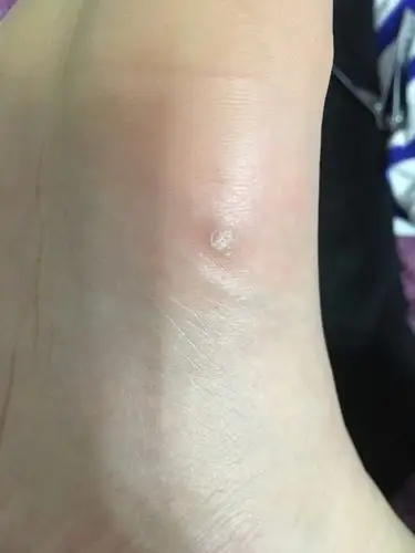 脚底长了个这个是怎么回事 不痛不痒的 比其他的皮肤高