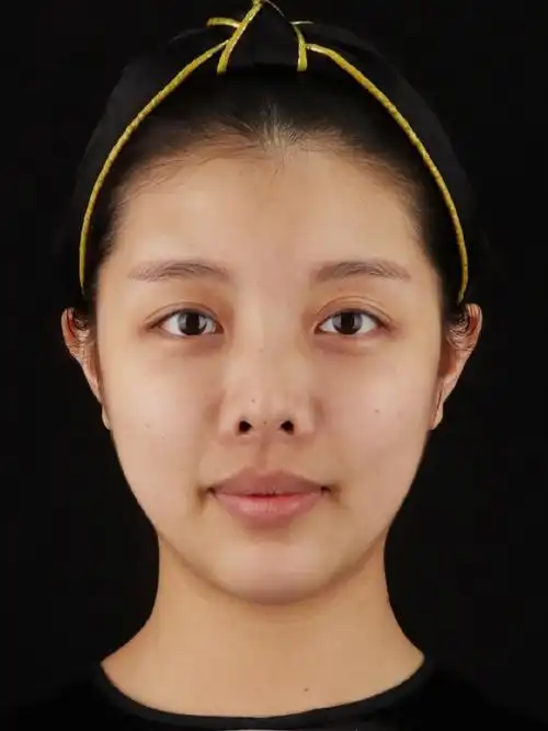 贴面耳正面看不见耳朵显脸大五官不立体