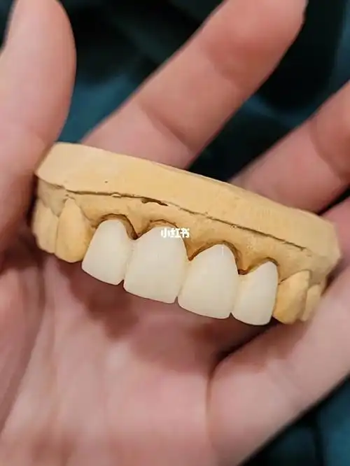 前牙临时牙真的很难做