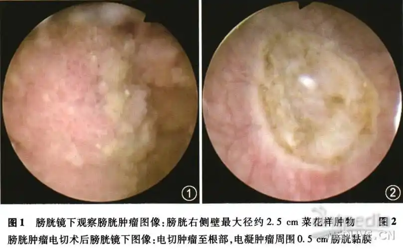 早期膀胱癌的内镜下治疗及分析