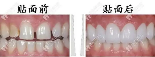 牙齿瓷贴面前后对比