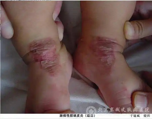 肠病性肢端皮炎的预防措施