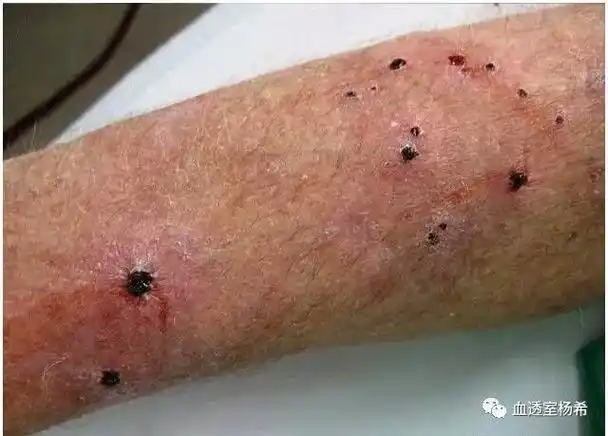 经典尿毒症皮肤瘙痒怎么办