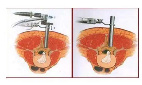 科普!腰椎间盘突出普遍关心的手术治疗相关问题