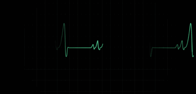 28岁女子一晚上心脏骤停50次这种病太可怕身体好的人反而易发