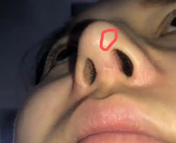 痛然后开始结黄痂是怎么回事是要假体外露了吗鼻孔也做的完全不一样急