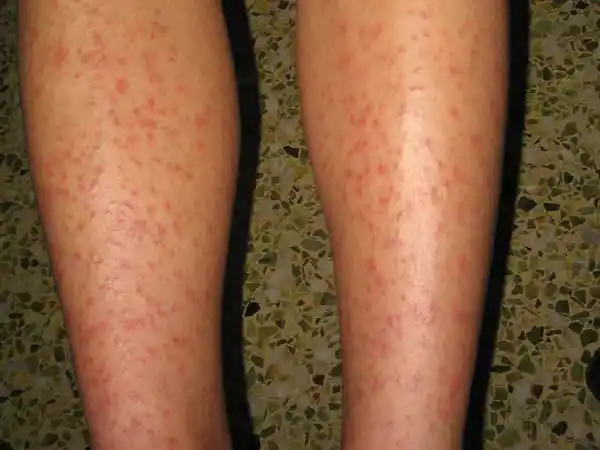 季节性皮肤病(疾病)_技点科普_技点网(疾病)