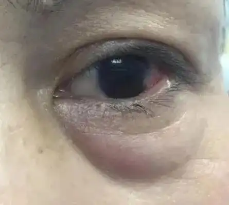 眼袋|卧蚕|下眼睑|黑眼圈|苹果肌_网易订阅