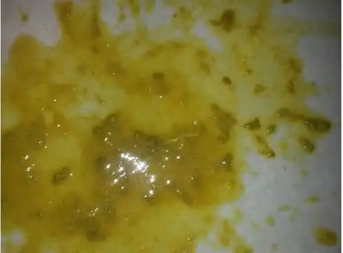 宝宝拉的都是水状的蛋花便,上吐下泻且发烧,你碰到过吗