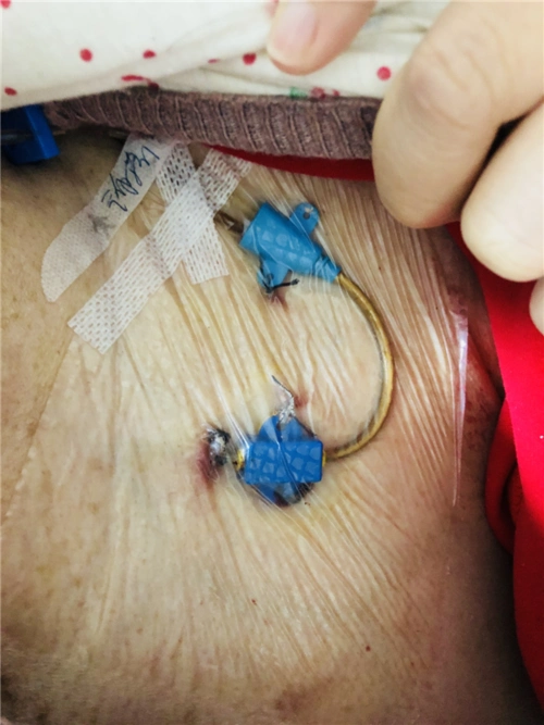 肿瘤护理专业委员会常务委员,完成个案管理师培训,熟悉锁骨