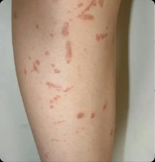 皮肤扁平疣图片