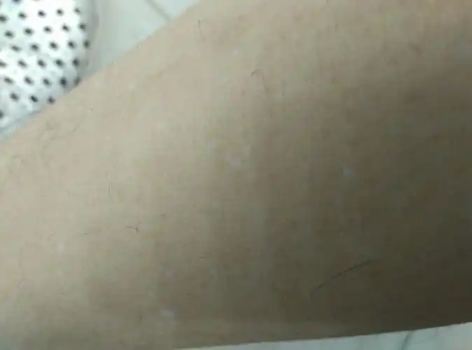 小腿上长了好多小白点是什么原因?