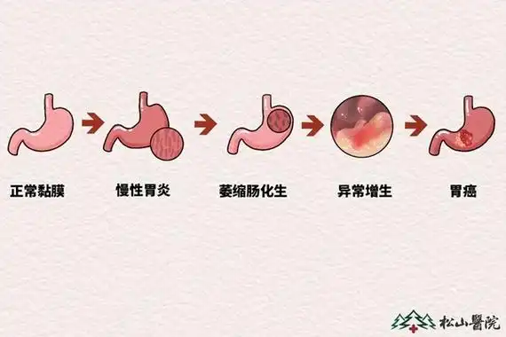 萎缩性胃炎如何"逆转"?松山医院:根除幽门杆菌是关键