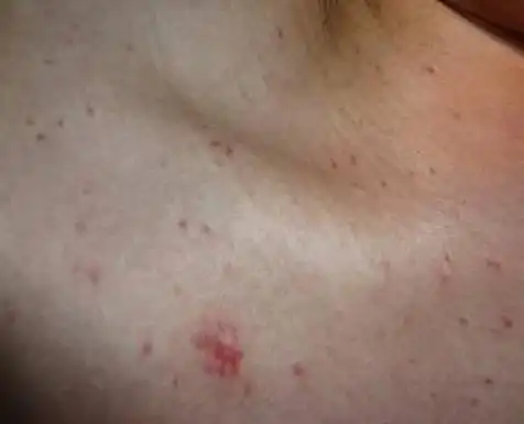 肝炎容易拖成肝癌,医生:身体若有2红,2痛,尽早检查