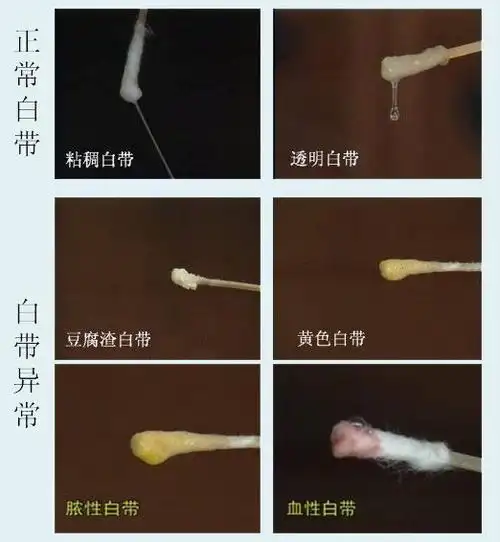 白带异常的症状及判断?_淮北友好妇产医院