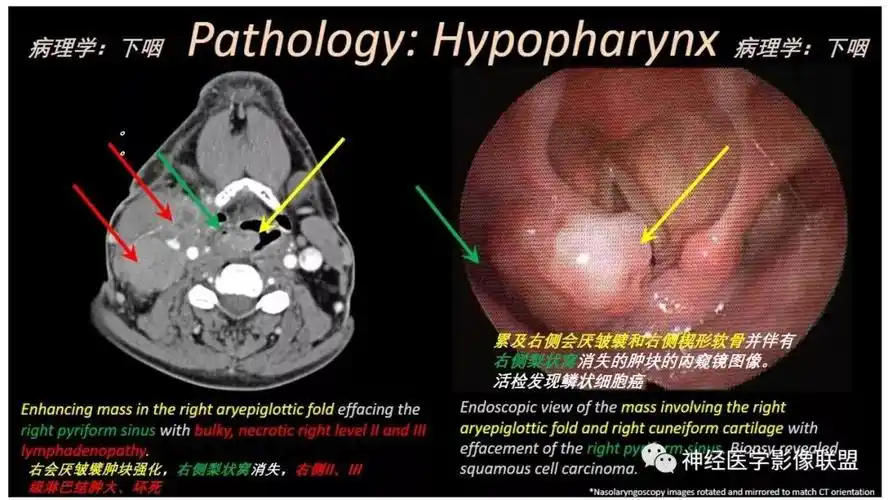 影像解剖喉部ct解剖简单