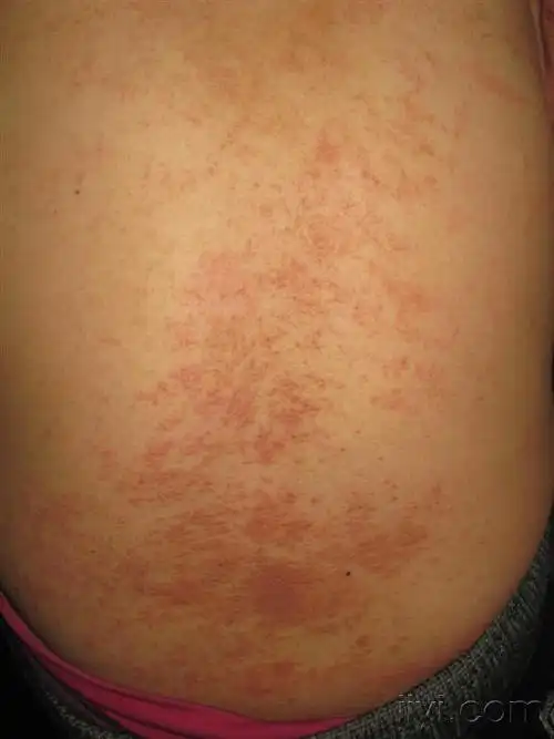 看图识病---------湿疹 - 皮肤及性传播疾病讨论版 - 爱爱医医学论坛