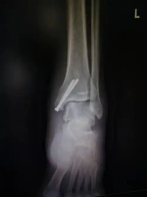 脚崴了,要拍个片吗?_韧带_小方_受伤