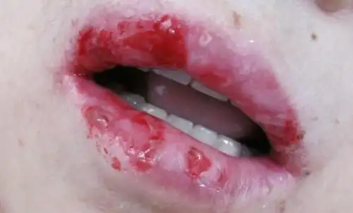 老年人嘴唇溃烂,起泡,有出血,是怎么回事问题已结束讨论