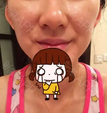 打瘦脸针失败,脸颊竟然变成葫芦脸,该怎么办?