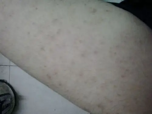 阴茎长毛囊炎的症状图片