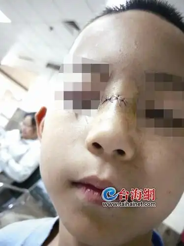 小孩鼻梁被划伤