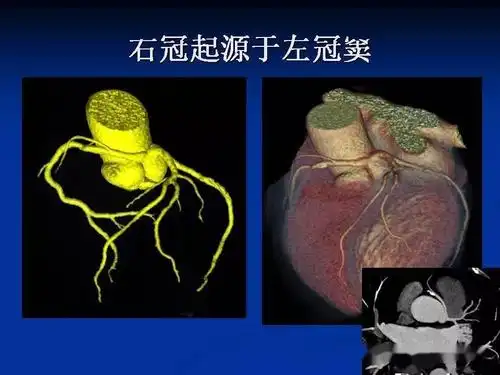 详细解读冠状动脉及冠心病ct