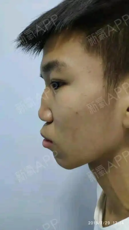 我的鼻子先天性畸形,先天凹陷型鼻畸形重度鞍鼻畸形鼻_圈子-新氧美容