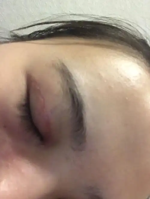 做了双眼皮17天了,这个是增生了吗