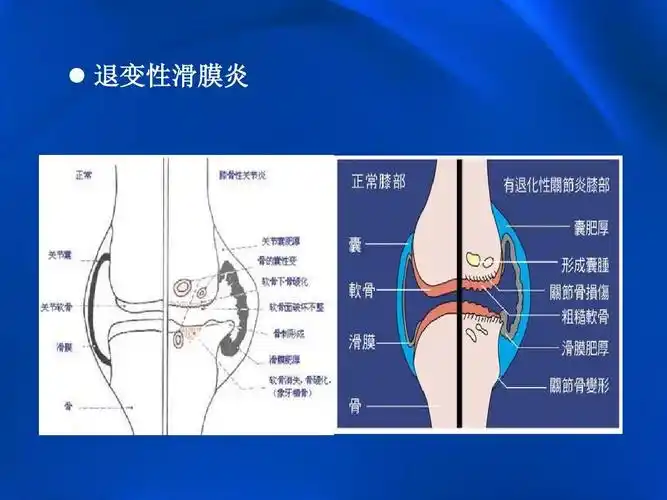 退变性滑膜炎