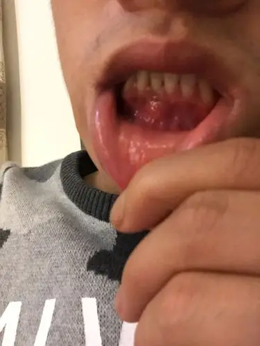 我的下牙床牙龈处长了包,挺硬的,但是不痛,请问这是怎么回事,有没有