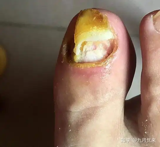 1招脱掉病甲,3步去除灰指甲,自己在家治好了灰指甲,经验分享! - 知乎