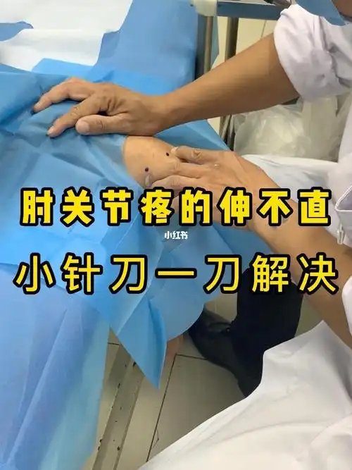 网球肘疼的睡不着做了一次小针刀不疼了