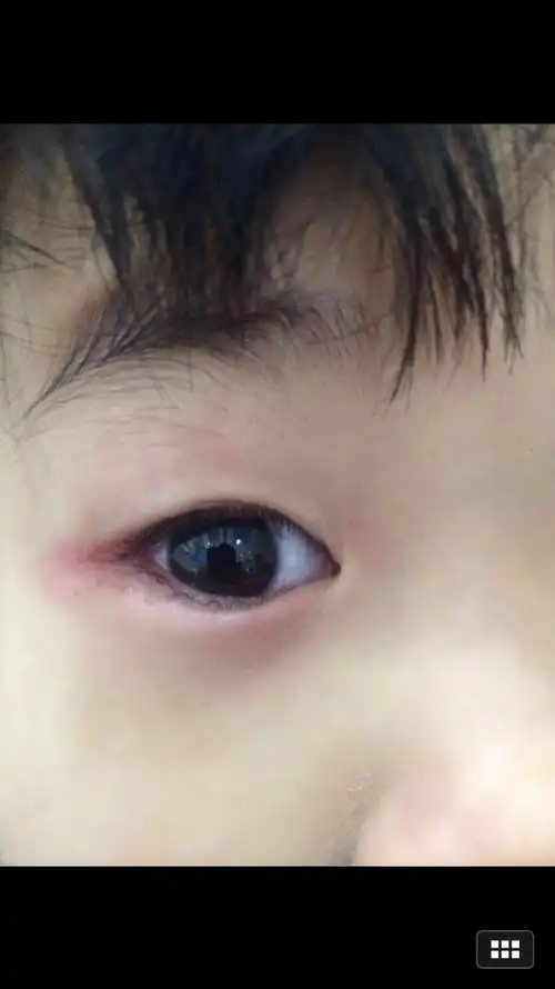 林大夫您好抱歉打扰了我儿子在两岁的时候右眼角红过大概半年