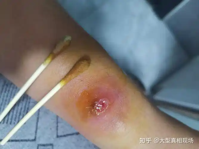 记一笔长疖肿火疖子自己治疗的过程