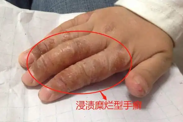 真菌性手癣图片_图文_文章_美咯_让您放心美!