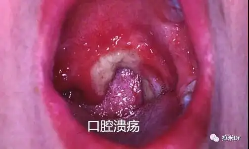 「小白科普」谨记别忘了口腔黏膜健康!