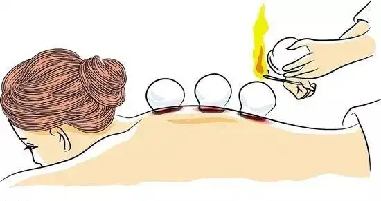 当拔罐成为一种时尚